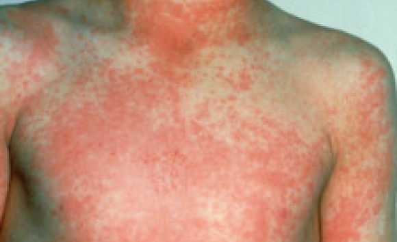 Wysypka w szkarlatynie