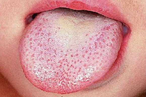 Typowy dla szkarlatyny "malinowy język" pokryty białym nalotem